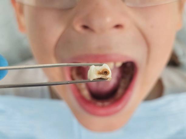 Best Emergency Dental Extractions in Woodville, TX