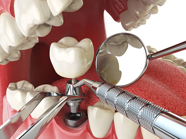 Best Emergency Root Canal Treatment in Woodville, TX